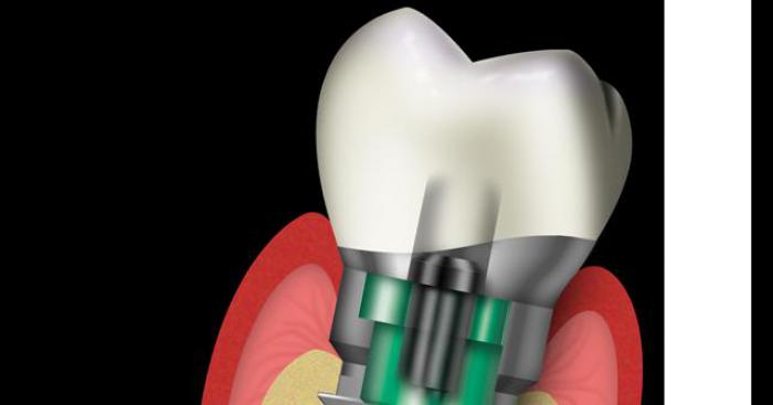 Insolite, un dentiste trouve un implant dans une molaire.