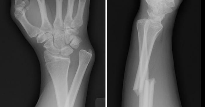 Double fracture suite à une mauvaise blague